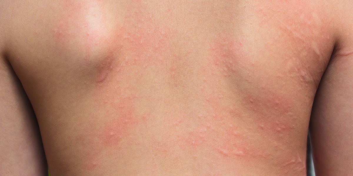 アレルギー性接触皮膚炎の治療