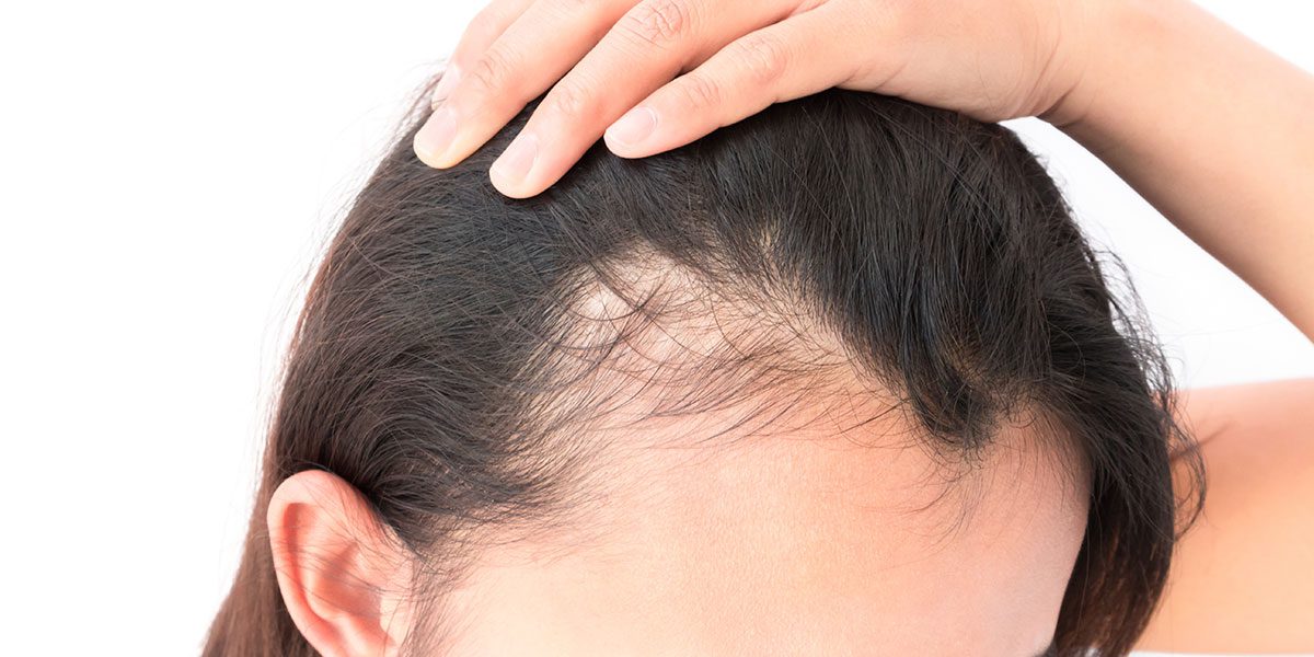 Hair loss in women: what are the triggers? | MDhair