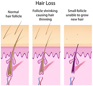 Androgenetic Hair Loss Treatment | Norris Dermatology Portland OR