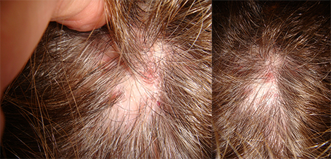 Hair Loss Scarring Alopecia Treatment | Norris Dermatology Portland