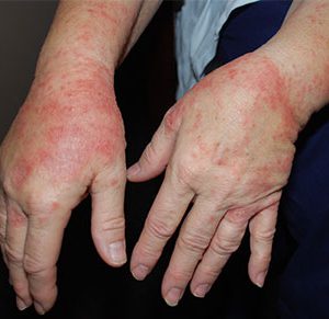rubber glove allergy