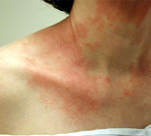 differentiating between eczema and a rash