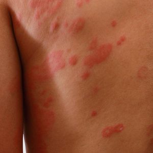 Portland Eczema Treatments