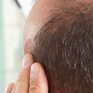 Hair Loss Treatment