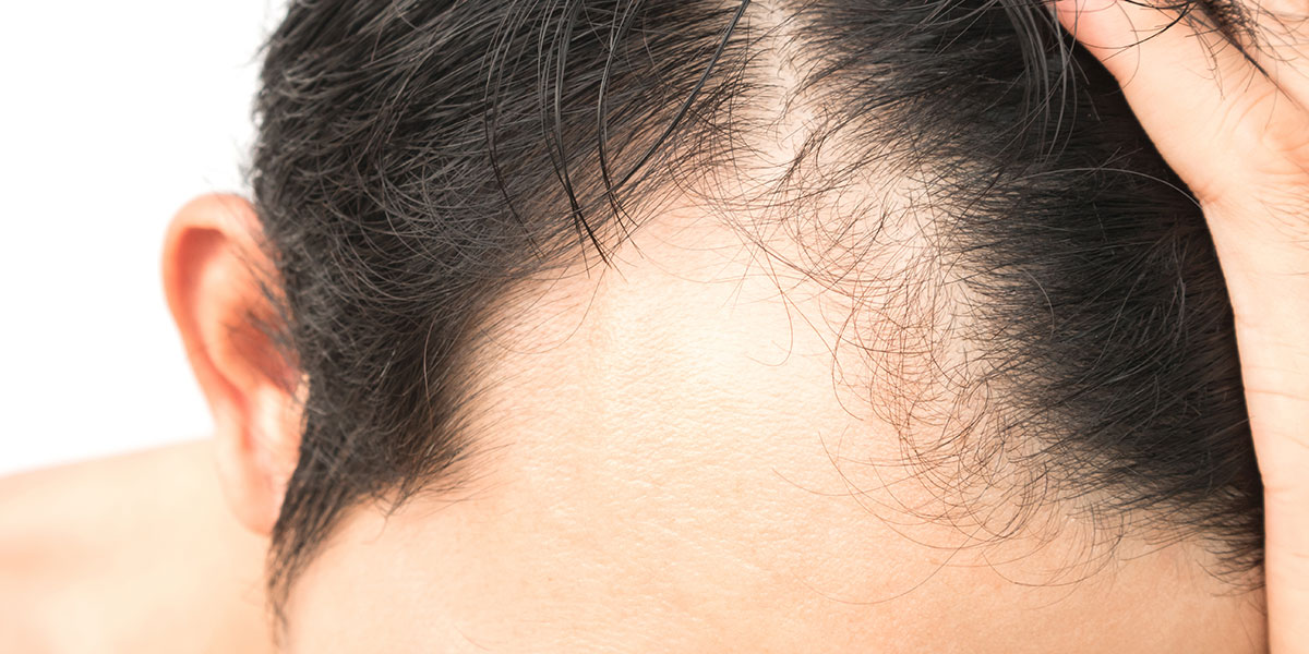 Alopecia Areata Hair Loss Treatment | Norris Dermatology Portland OR