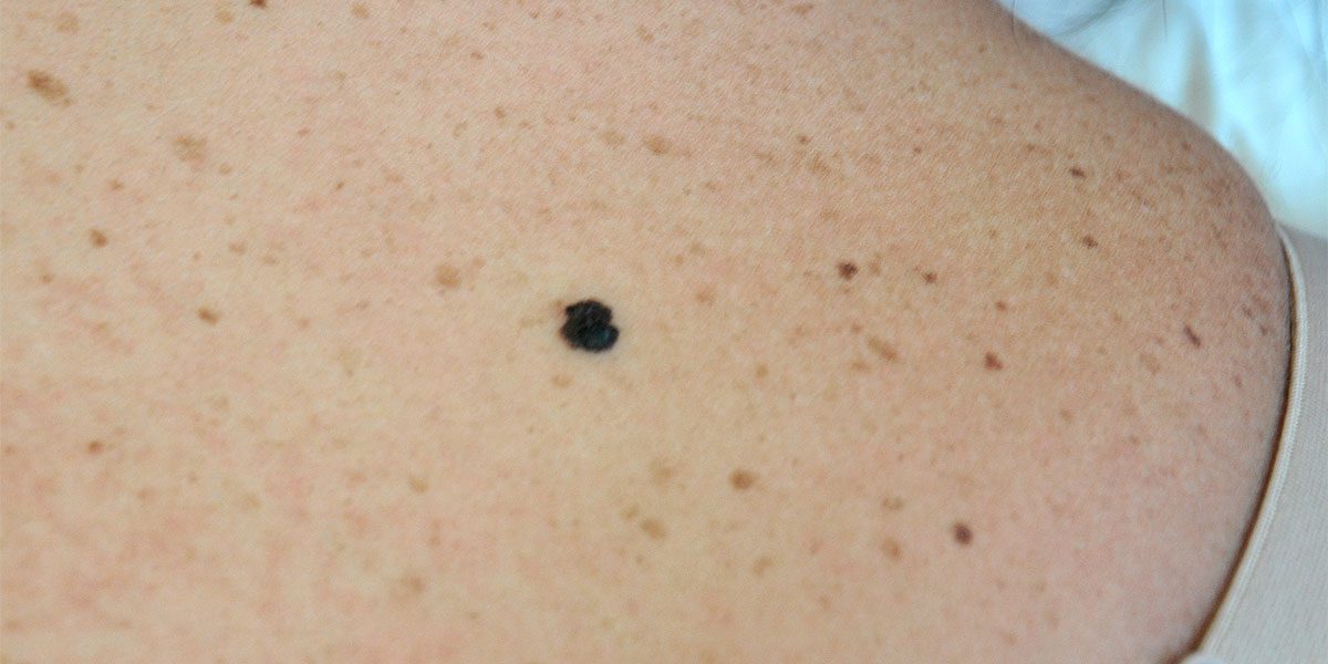 Melanoma Skin Cancer Treatment