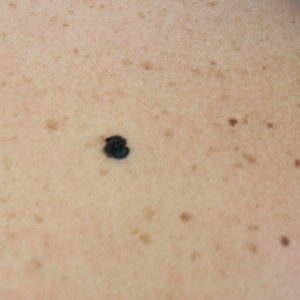 Portland Melanoma Treatment