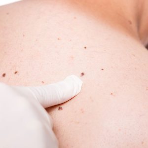 Portland Mole Dermatologist