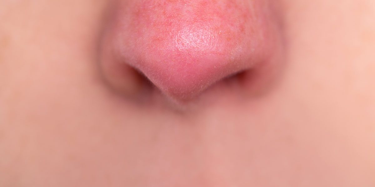 Portland Rosacea Treatments