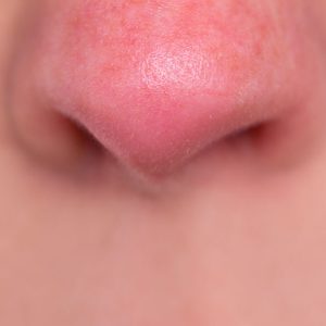 Portland Rosacea Treatments