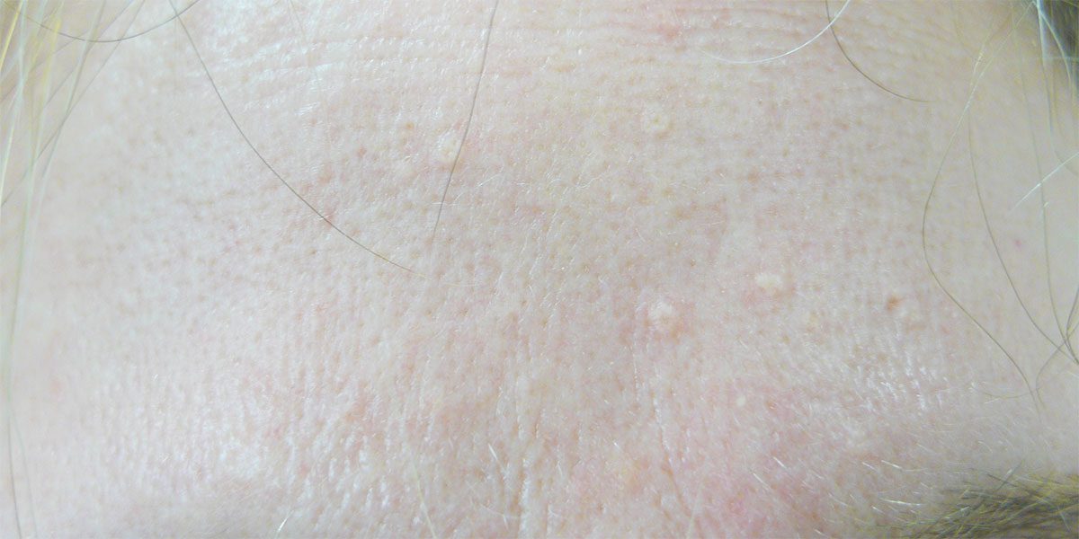 Sebaceous Hyperplasia Treatment