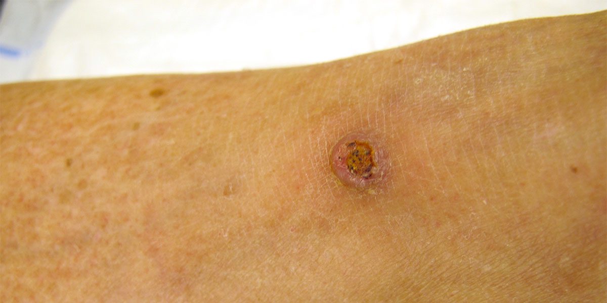 Squamous Cell Carcinoma Treatment