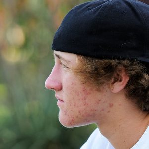 Portland Severe Acne Treatments