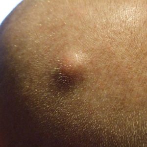 Sebaceous cyst