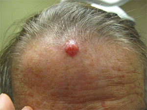 Portland Basal Cell Carcinoma Treatment