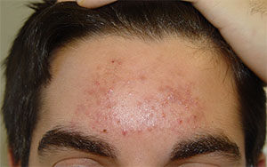 Acne on forehead