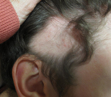 Portland Hair Loss Treatment