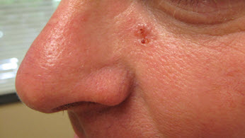 Portland Basal Cell Carcinoma Treatment