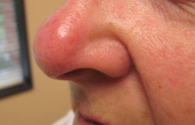 Portland Rosacea Treatment