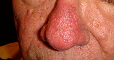 Rhinophyma of the nose