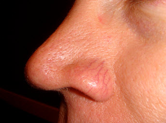 Superficial blood vessels around the nose are common in Rosacea