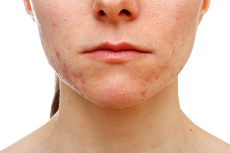 Portland Acne Scar Doctor Dermatologist